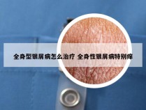 全身型银屑病怎么治疗 全身性银屑病特别痒