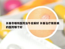 长春市哪所医院治牛皮癣好 长春治疗银屑病的医院哪个好