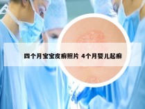 四个月宝宝皮癣照片 4个月婴儿起癣