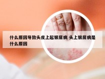 什么原因导致头皮上起银屑病 头上银屑病是什么原因