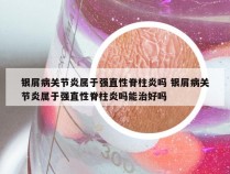 银屑病关节炎属于强直性脊柱炎吗 银屑病关节炎属于强直性脊柱炎吗能治好吗