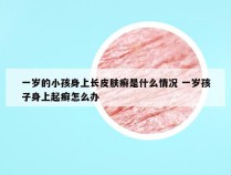 一岁的小孩身上长皮肤癣是什么情况 一岁孩子身上起癣怎么办