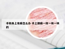 手和身上有癣怎么办 手上跟癣一样一块一块的