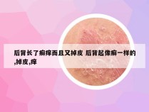 后背长了癣痒而且又掉皮 后背起像癣一样的,掉皮,痒