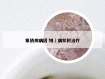 银俏病病因 银痟病如何治疗