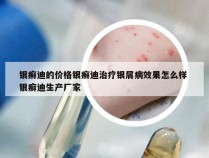 银癣迪的价格银癣迪治疗银屑病效果怎么样 银癣迪生产厂家