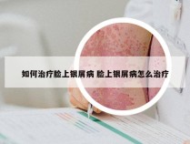 如何治疗脸上银屑病 脸上银屑病怎么治疗