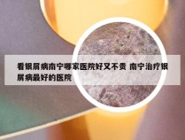 看银屑病南宁哪家医院好又不贵 南宁治疗银屑病最好的医院