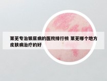 莱芜专治银屑病的医院排行榜 莱芜哪个地方皮肤病治疗的好