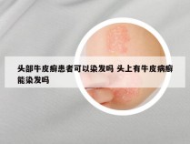 头部牛皮癣患者可以染发吗 头上有牛皮病癣能染发吗