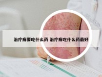 治疗癣要吃什么药 治疗癣吃什么药最好