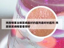 陕西哪里治银屑病最好的医院最好的医院 陕西银屑病哪里看得好