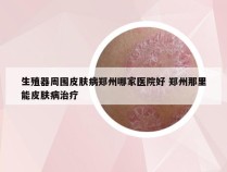 生殖器周围皮肤病郑州哪家医院好 郑州那里能皮肤病治疗