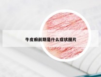 牛皮癣前期是什么症状图片