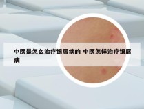 中医是怎么治疗银屑病的 中医怎样治疗银屑病