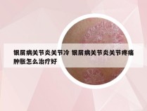 银屑病关节炎关节冷 银屑病关节炎关节疼痛肿胀怎么治疗好