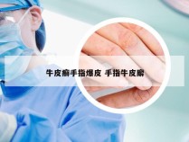 牛皮癣手指爆皮 手指牛皮廨