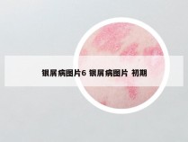 银屑病图片6 银屑病图片 初期