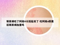 银屑病吃了阿维A以后起皮了 吃阿维a胶囊后银屑病加重吗