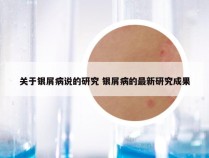 关于银屑病说的研究 银屑病的最新研究成果