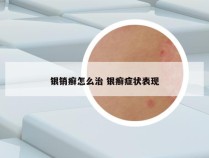 银销癣怎么治 银癣症状表现