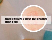 我国就没有能治银屑病的药 目前国内治疗银屑病的生物药