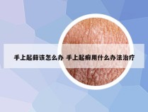 手上起藓该怎么办 手上起癣用什么办法治疗