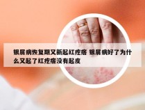 银屑病恢复期又新起红疙瘩 银屑病好了为什么又起了红疙瘩没有起皮