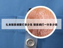 礼来银屑病要打多少支 银屑病打一针多少钱