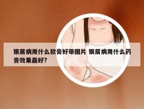 银屑病用什么软膏好带图片 银屑病用什么药膏效果最好?