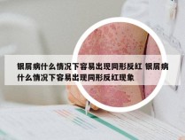 银屑病什么情况下容易出现同形反红 银屑病什么情况下容易出现同形反红现象