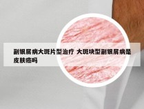 副银屑病大斑片型治疗 大斑块型副银屑病是皮肤癌吗