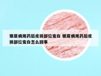 银屑病用药后皮损部位变白 银屑病用药后皮损部位变白怎么回事