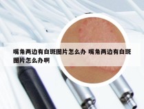 嘴角两边有白斑图片怎么办 嘴角两边有白斑图片怎么办啊