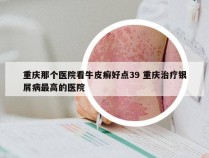 重庆那个医院看牛皮癣好点39 重庆治疗银屑病最高的医院