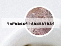 牛皮鲜有治愈的吗 牛皮鲜能治愈不复发吗