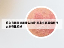 脸上有银屑病用什么软膏 脸上有银屑病用什么软膏比较好