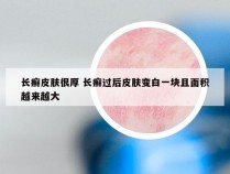 长癣皮肤很厚 长癣过后皮肤变白一块且面积越来越大