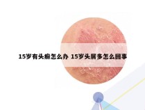 15岁有头癣怎么办 15岁头屑多怎么回事