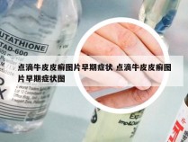 点滴牛皮皮癣图片早期症状 点滴牛皮皮癣图片早期症状图