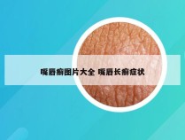 嘴唇癣图片大全 嘴唇长癣症状