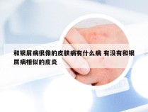 和银屑病很像的皮肤病有什么病 有没有和银屑病相似的皮炎