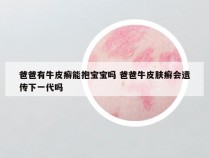 爸爸有牛皮癣能抱宝宝吗 爸爸牛皮肤癣会遗传下一代吗