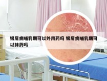 银屑病哺乳期可以外用药吗 银屑病哺乳期可以抹药吗