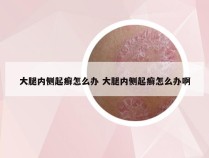 大腿内侧起癣怎么办 大腿内侧起癣怎么办啊