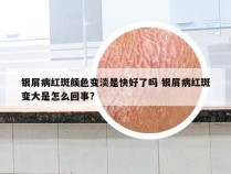 银屑病红斑颜色变淡是快好了吗 银屑病红斑变大是怎么回事?