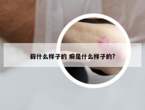 藓什么样子的 癣是什么样子的?