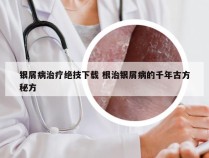 银屑病治疗绝技下载 根治银屑病的千年古方秘方