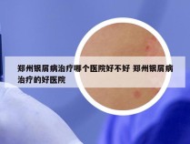 郑州银屑病治疗哪个医院好不好 郑州银屑病治疗的好医院