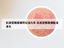 红皮型银屑病可以活几年 红皮型银屑病能活多久